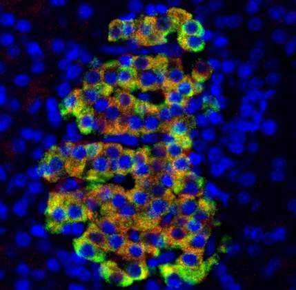 L'insulina appare verde, mentre cathelicidin peptidi antimicrobici (CAMP) appare rosso e il DNA di tutte le cellule appare blue.Giallo mostra una sovrapposizione di verde e rosso. Credit: Dr. Fraser Scott, l'ospedale di Ottawa