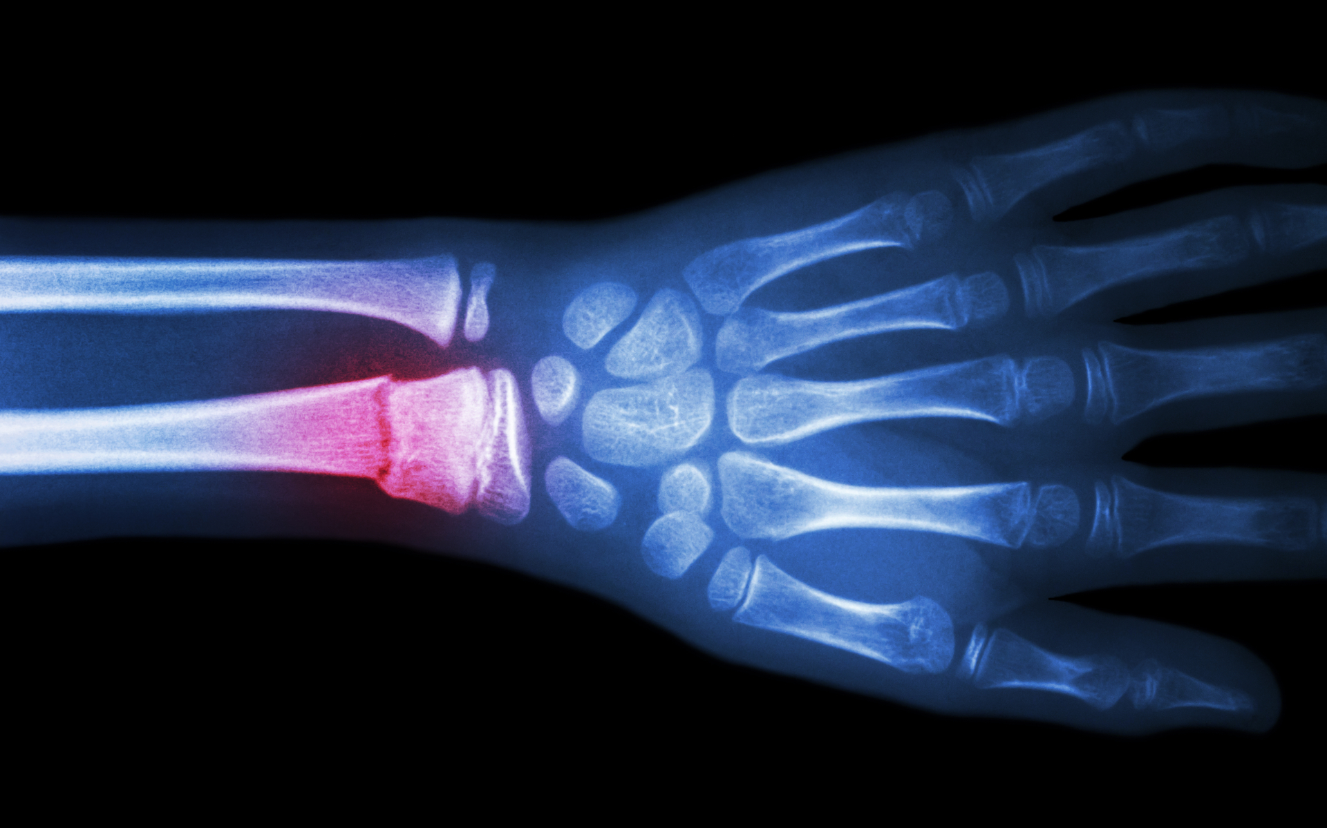 broken bone