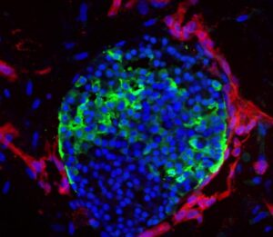 Il futuro è sotto pelle: isole pancreatiche stampate in 3D per combattere il diabete di tipo 1